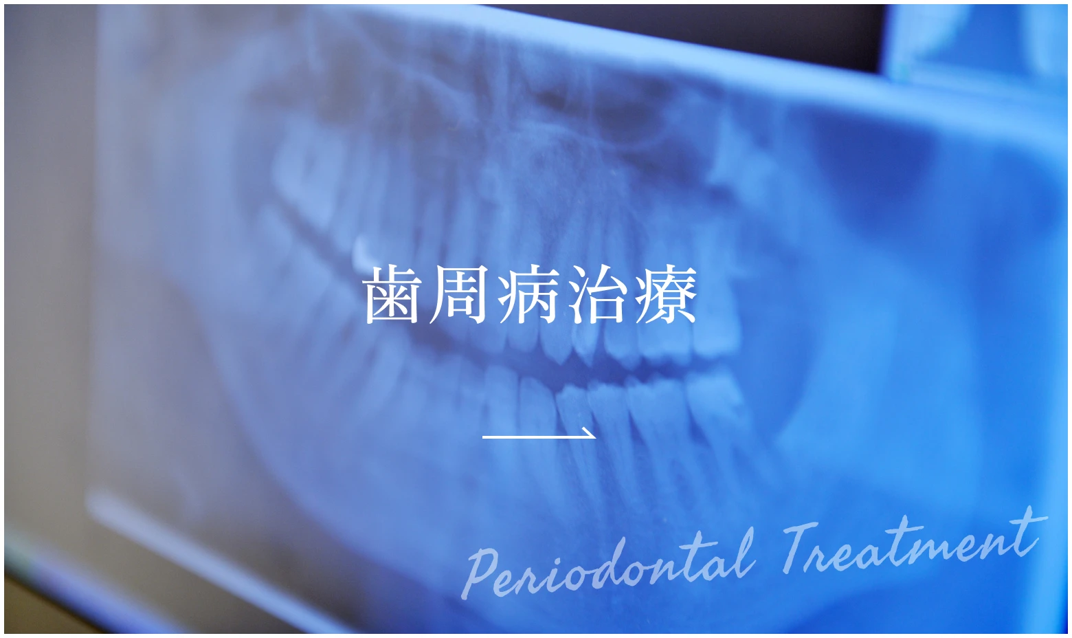 歯周病治療