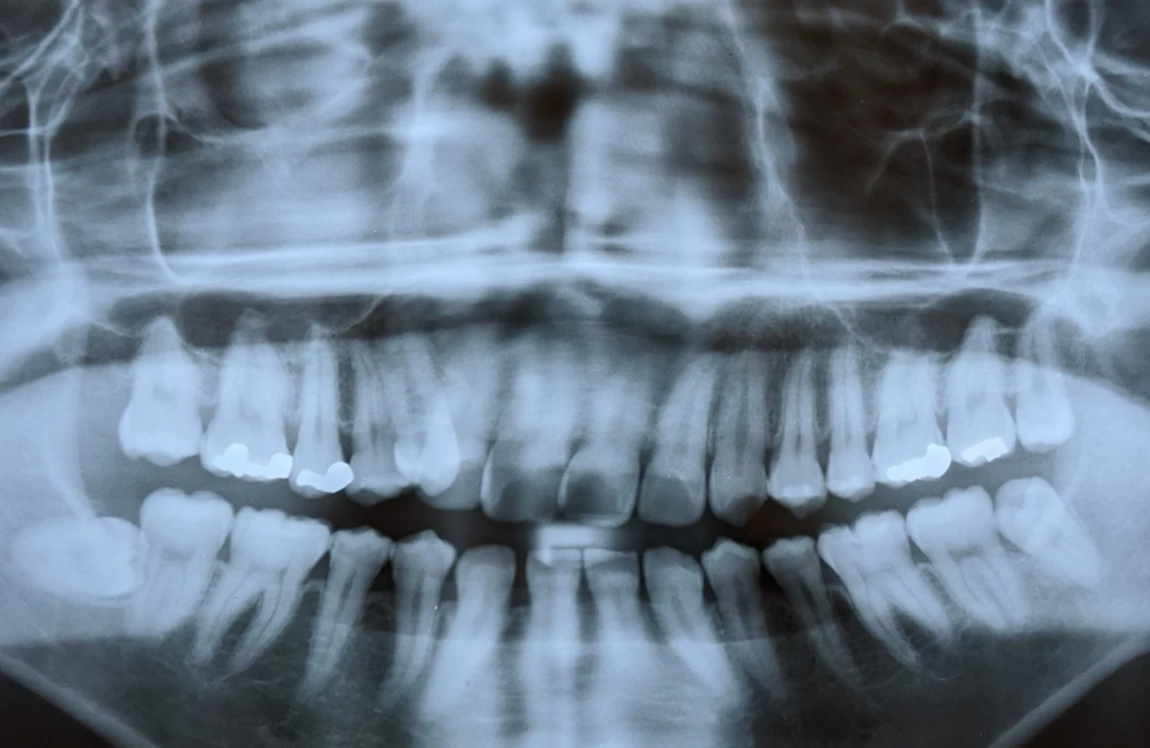 歯周病治療について
