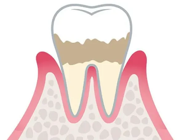 歯周炎（軽度）