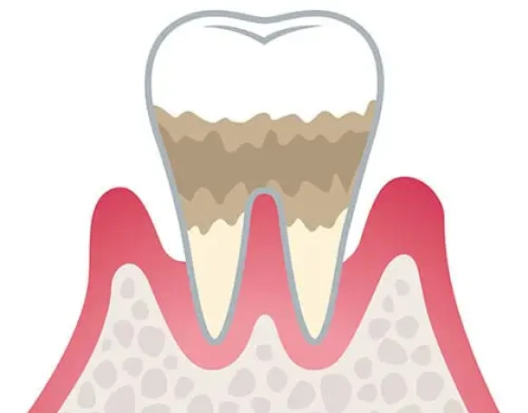 歯周炎（中度）