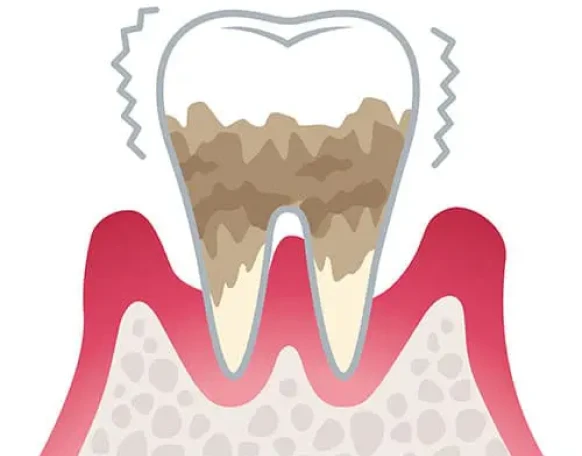 歯周炎（重度）