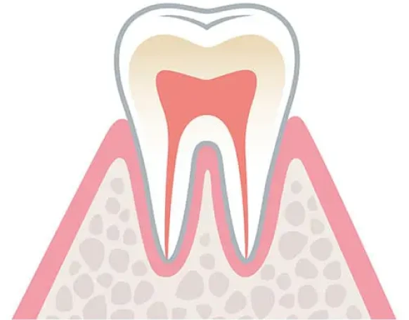 C0：虫歯になりかけの歯