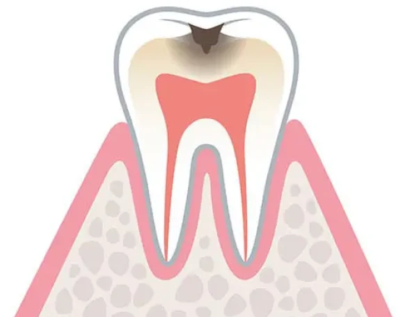 C2：象牙質の虫歯