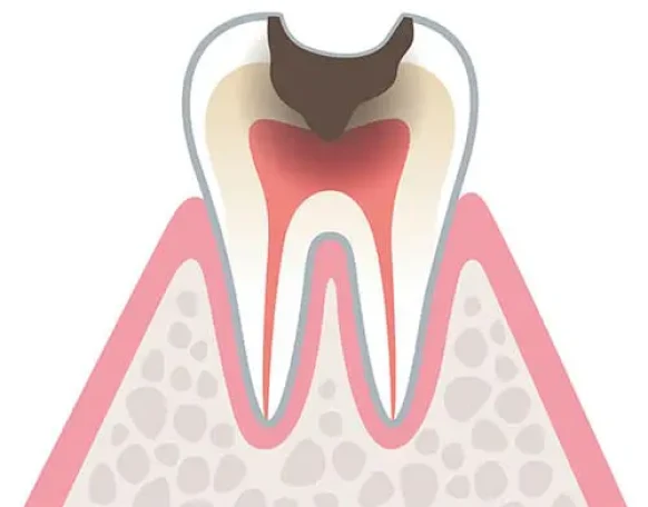 C3：神経まで達した虫歯