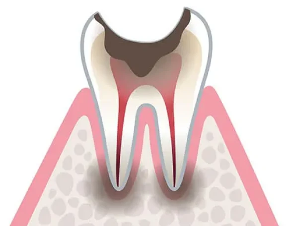 C4：歯冠部が崩壊した虫歯