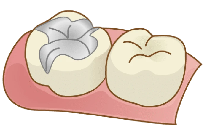 C0：虫歯になりかけの歯