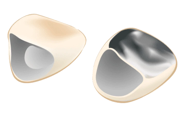 C3：神経まで達した虫歯