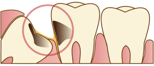 虫歯・歯周病になっている