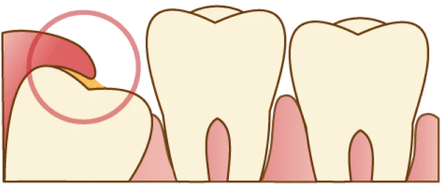 歯茎がかぶっている